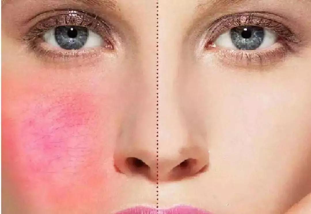 红血丝的四个雷区,关于红血丝你必须知道的几件事