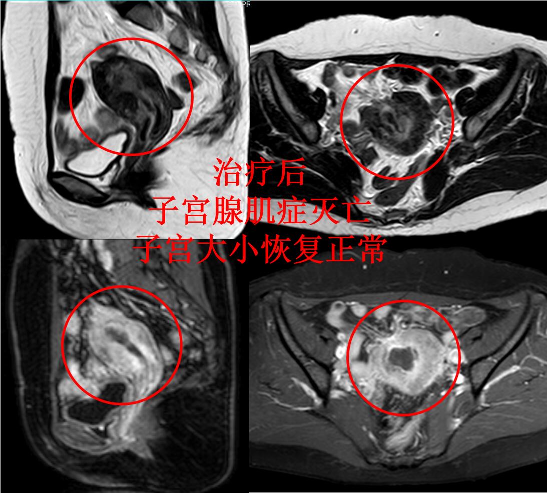 子宫腺肌症痛经中医能治好吗,子宫腺肌症引起的痛经艾灸哪里