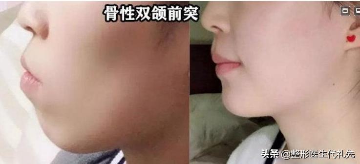 怎样才能拥有完美的下颌线,怎样让自己的下颌线更明显