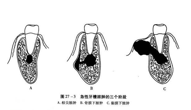 牙龈肿痛怎么缓解土方法,牙龈肿痛的正确方法
