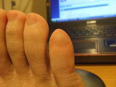 为什么很多人跑步后，都长出了“黑趾甲”？与3种原因离不开