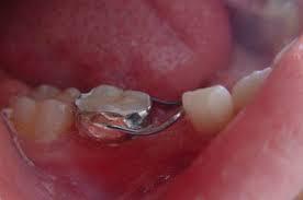 儿童牙齿口腔保健常识,家长们看过来儿童牙齿如何保护