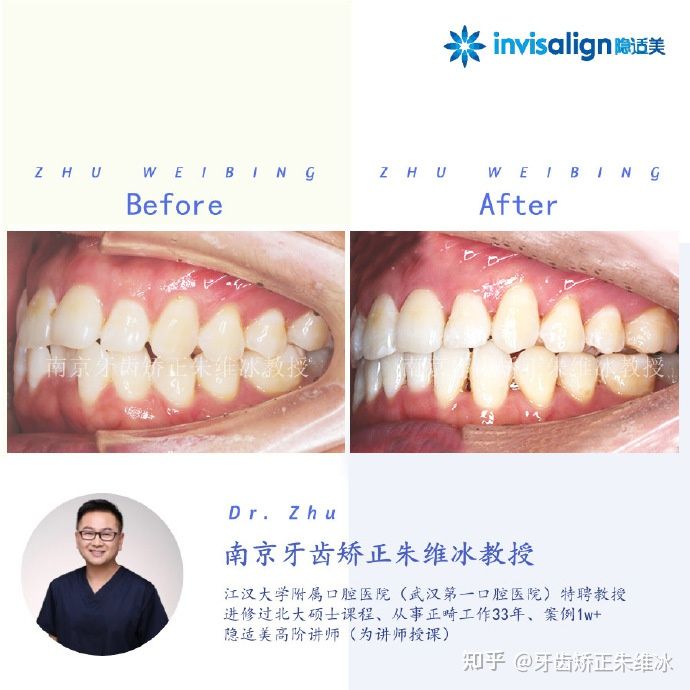 牙齿歪矫正,南京成人牙齿矫正牙齿不齐