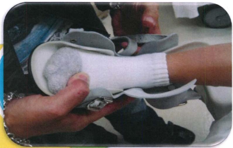 马蹄内翻足支具需要穿多久,马蹄内翻足穿鞋了怎么按摩