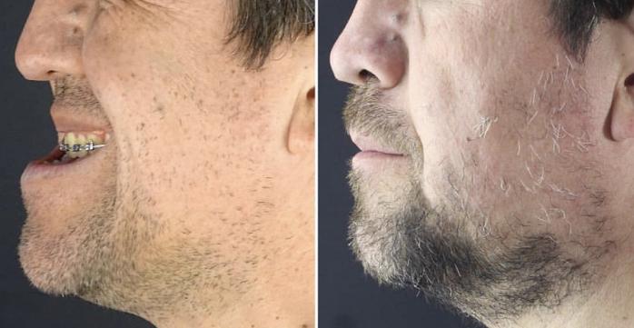 骨性龅牙怎么弄,如何判断骨性龅牙的轻重程度