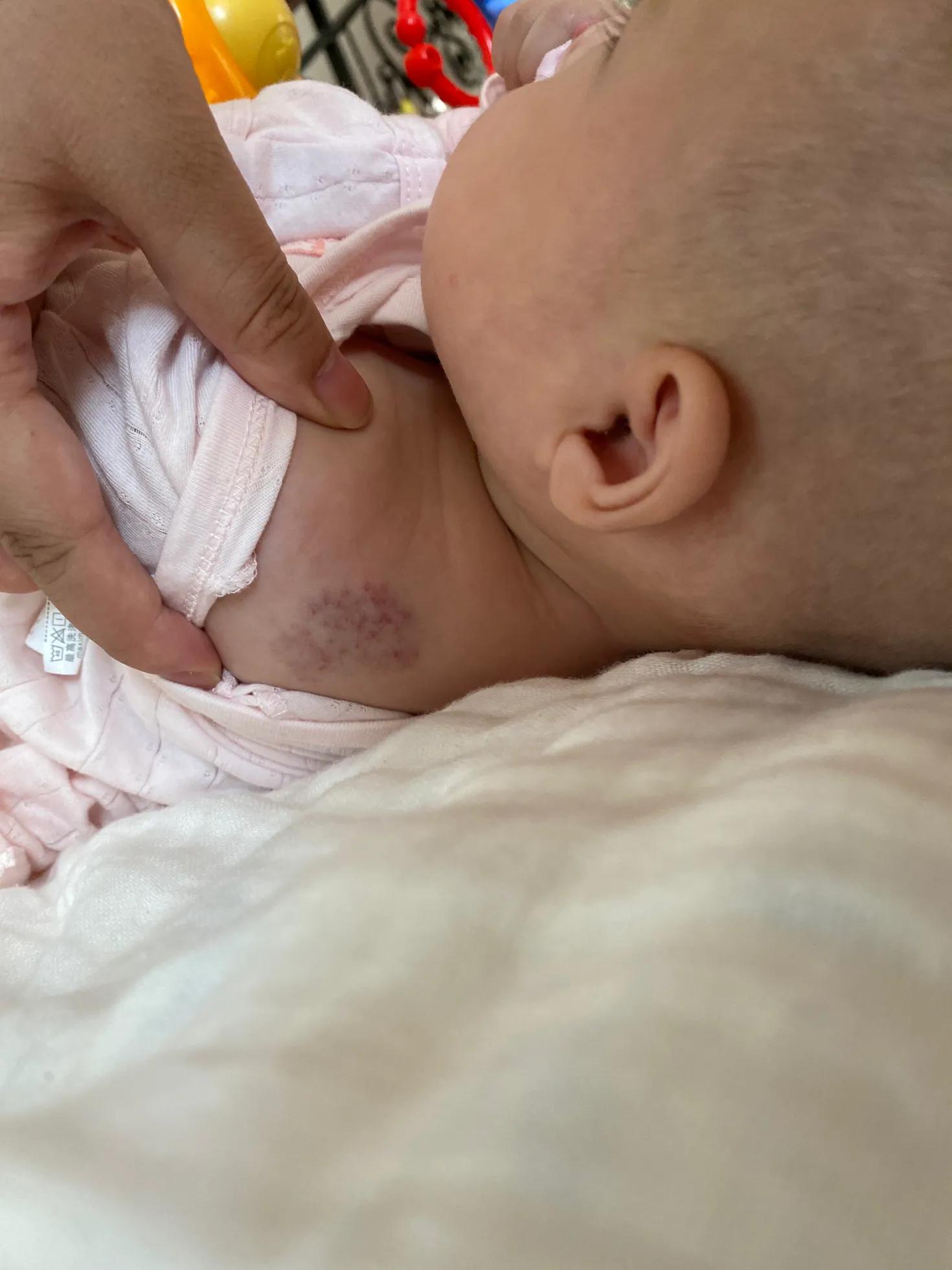 宝宝血管瘤用眼药水以后1个月淡化好多（带图）