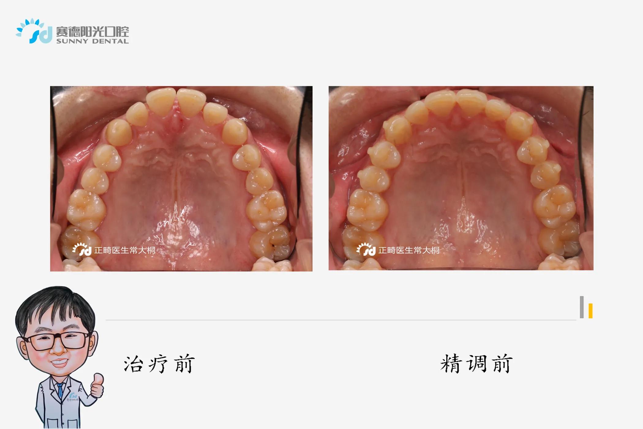 隐适美正畸牙拔掉不美观怎么办,隐适美黑三角什么时候会出现