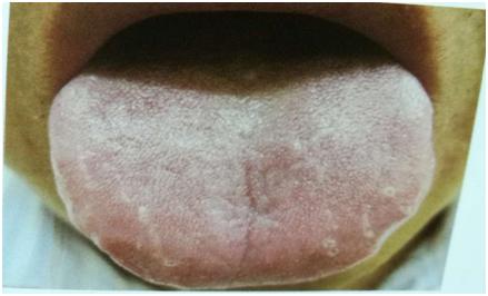 舌象大全及应对调理方法,中医教你从14种舌头的舌象看健康