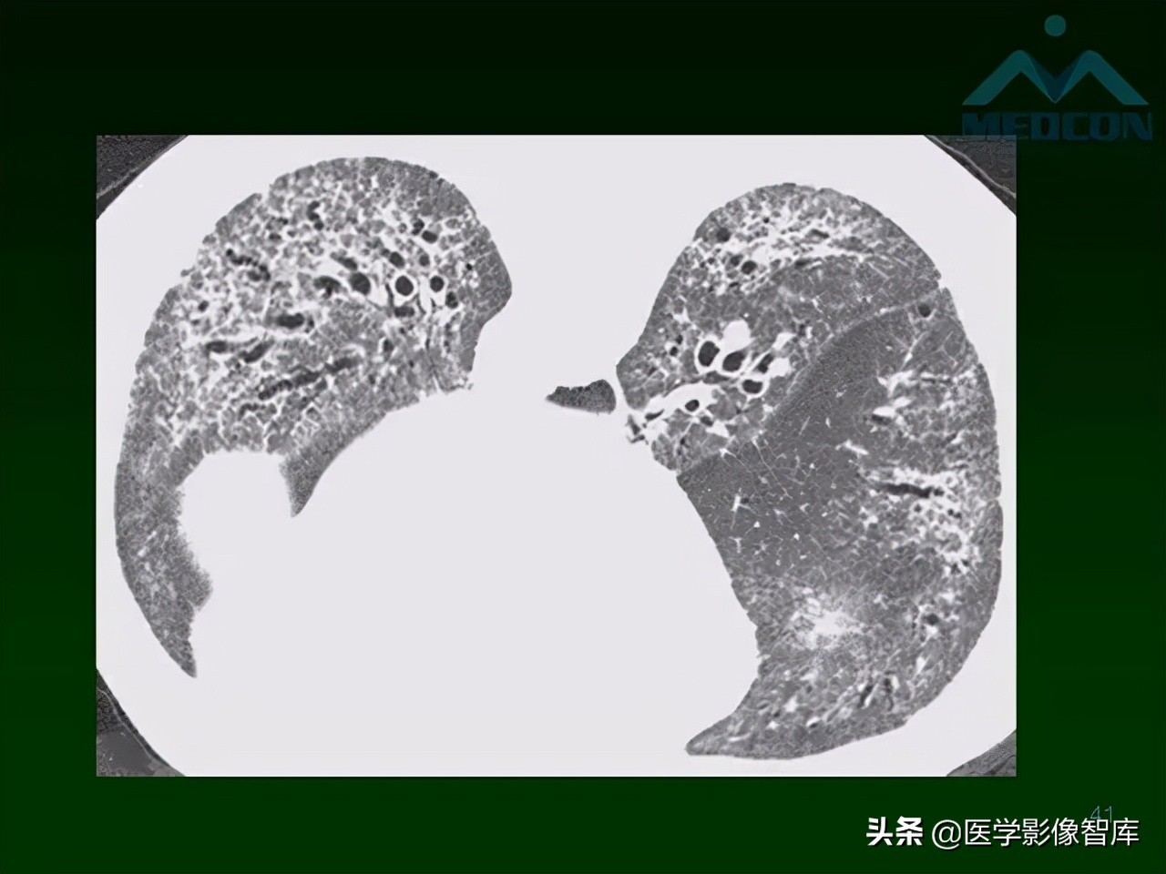 肺弥漫性网状影,两肺小叶间隔增厚可见网状模糊影