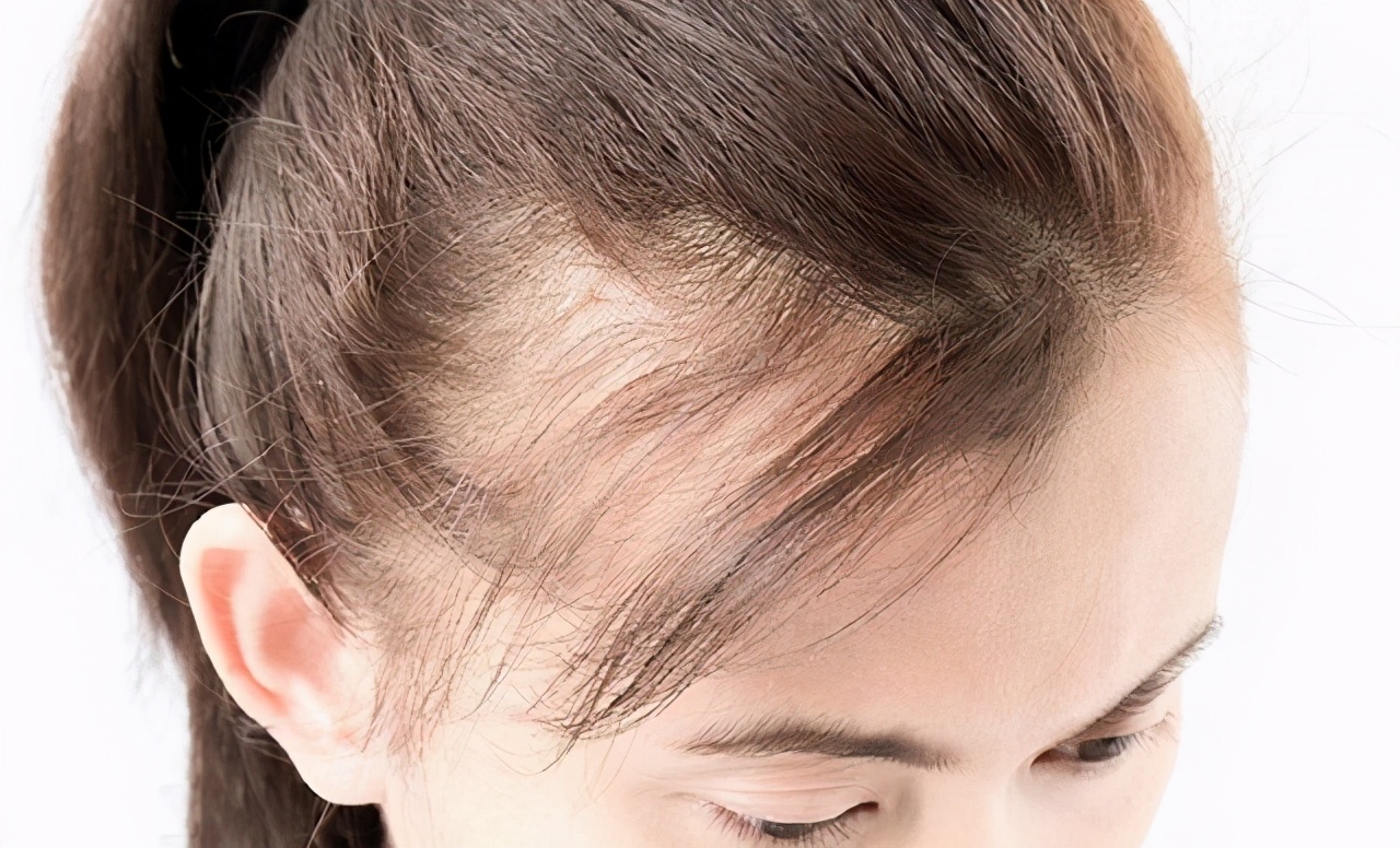 脱发大部分都是什么类型的脱发,脱发的最新标准治疗方法