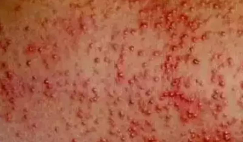 宝宝夏天起痱子需要抹药吗,婴儿夏天起痱子最有效的解决方法