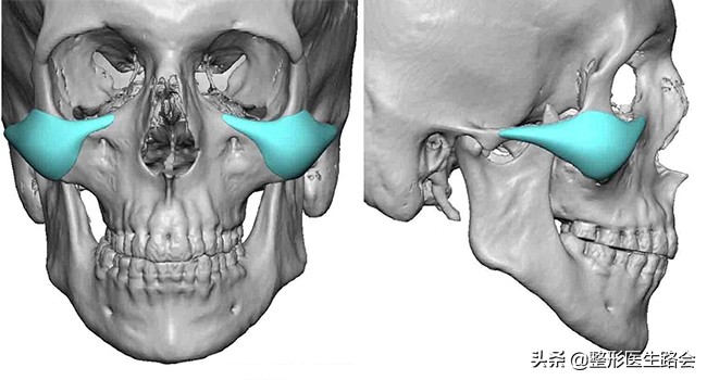 颧骨颧弓内推手术会让脸变小吗,颧骨内推手术有什么后遗症