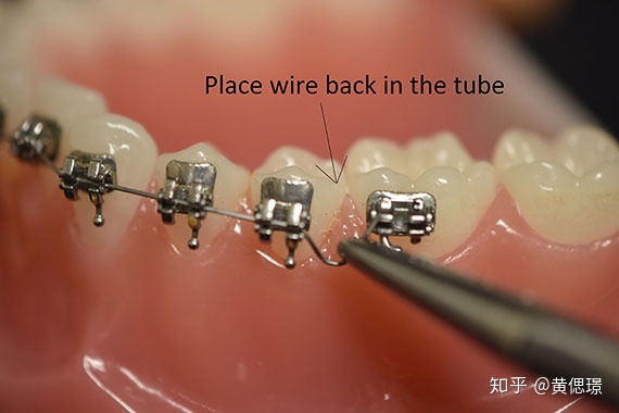 2021年春节期间牙套er应急自救指南