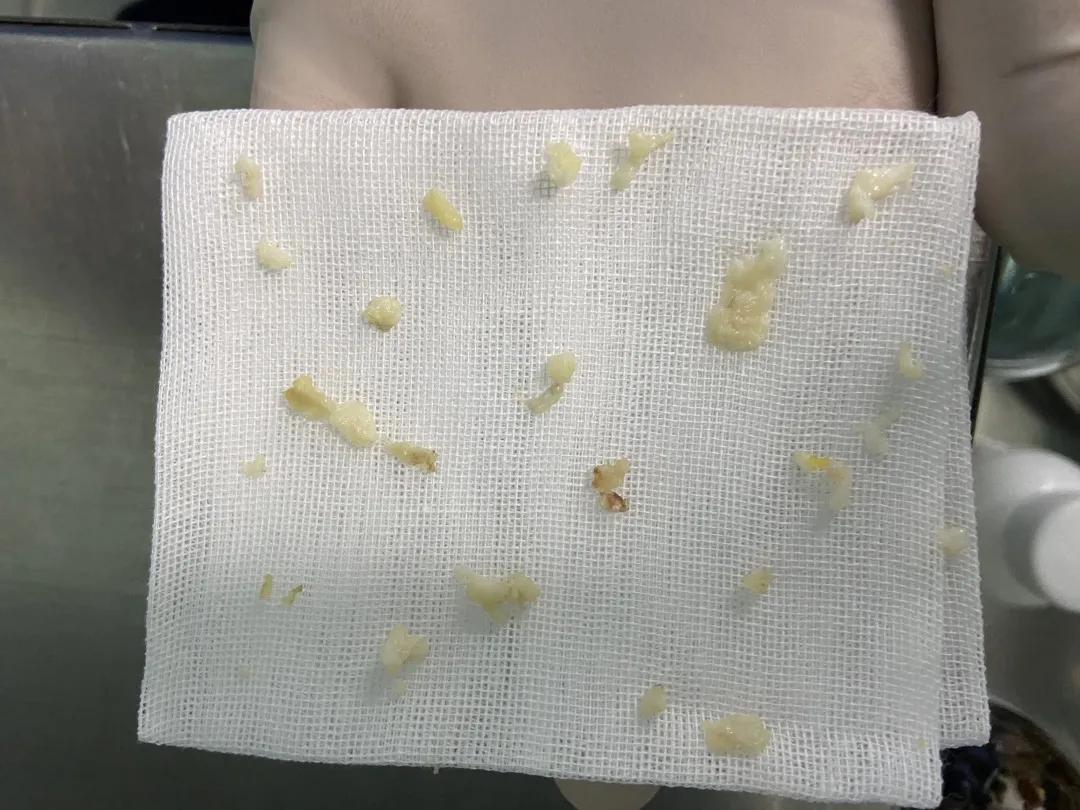 渭南治腰间盘突出哪家最好,脊柱神经外科手术