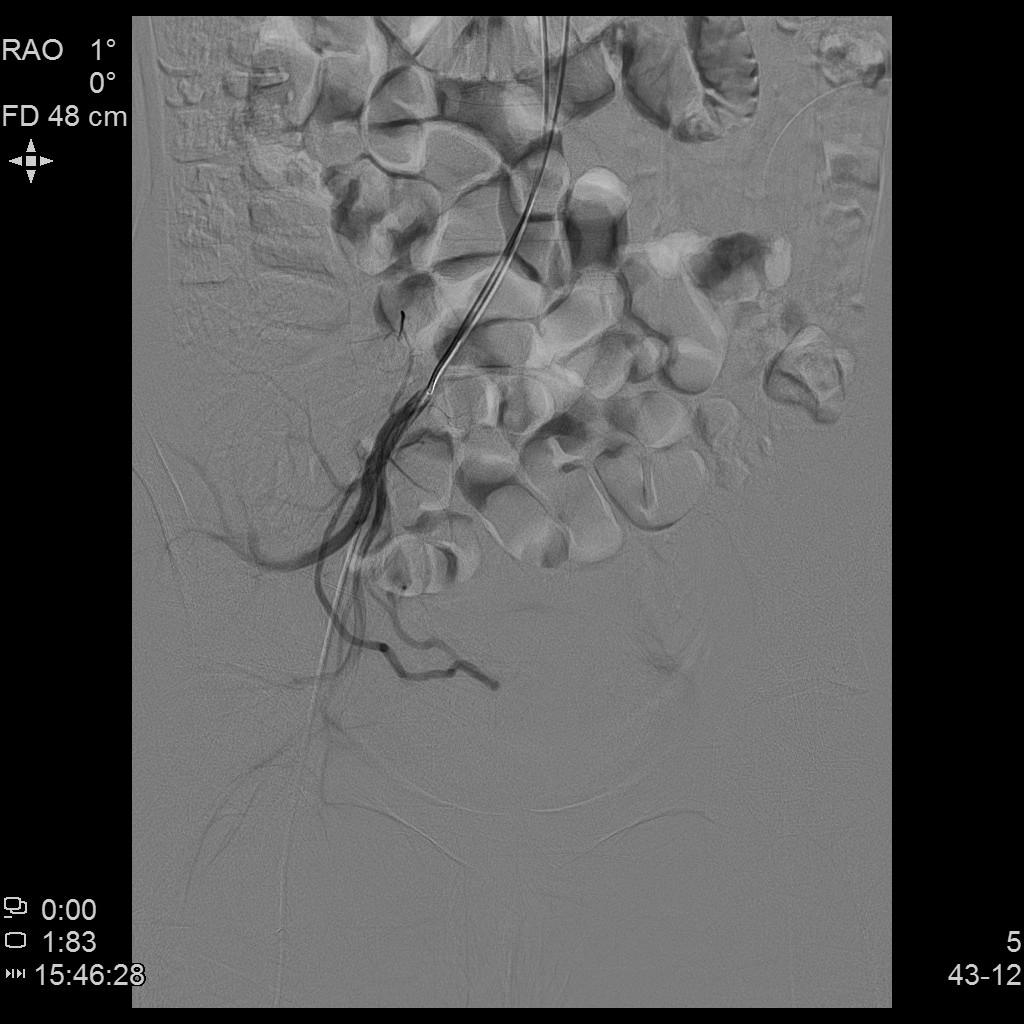子宫腺肌症「不死的癌症」——介入栓塞来帮忙
