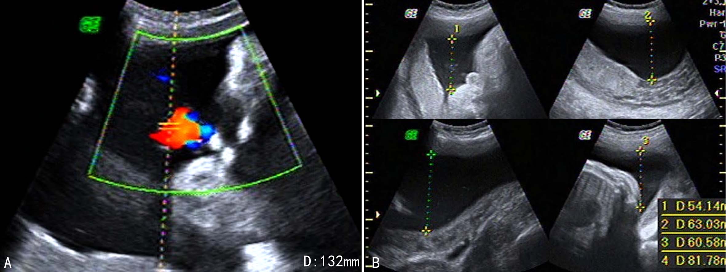 羊水彩超和普通彩超哪个更准,羊水异常的超声诊断