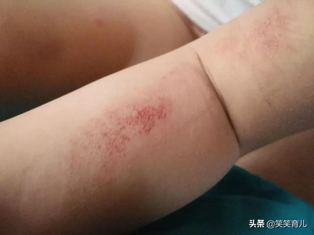 宝宝擦伤的正确处理方法,宝宝擦伤了该怎么办