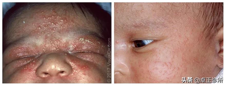 新生婴儿脸上皮疹怎么回事,新生宝宝面部红疹