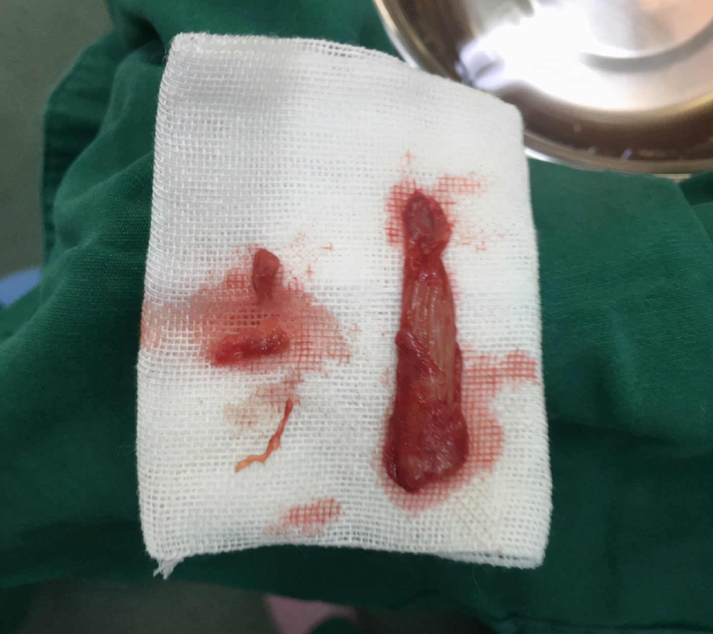 线雕鼻会有生命危险吗,线雕鼻的副作用有多可怕