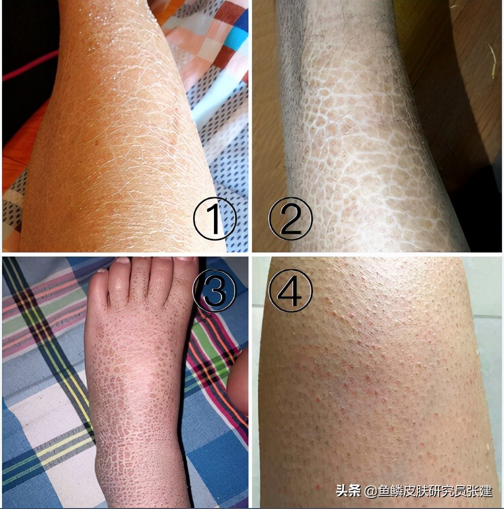小腿鱼鳞皮肤怎么消除最有效最快,女生鱼鳞皮肤怎么办