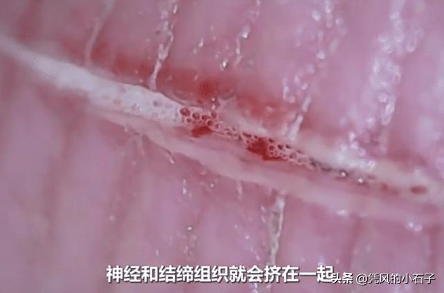 人受伤后伤口怎么愈合?显微镜放大100倍,看完长见识了