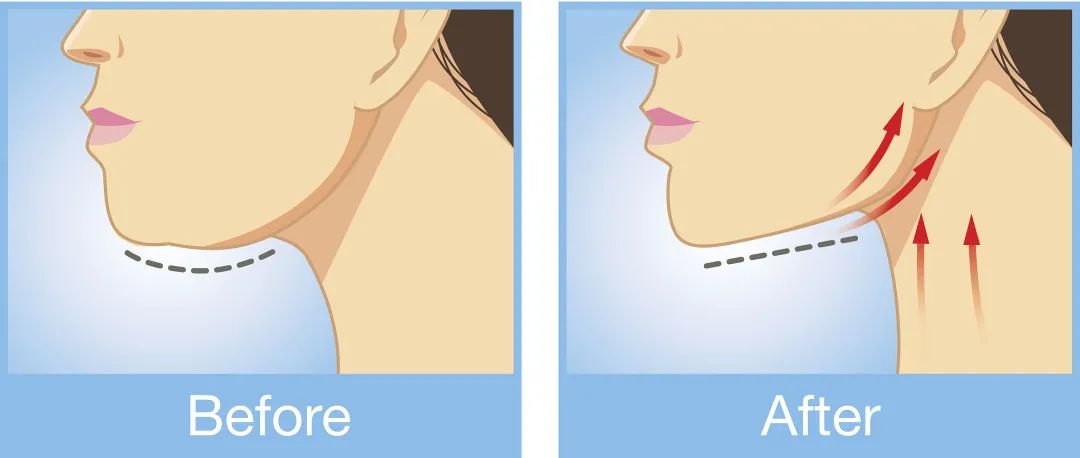 法令纹抬头纹眼纹颈纹,专治颈纹眼纹法令纹抬头纹