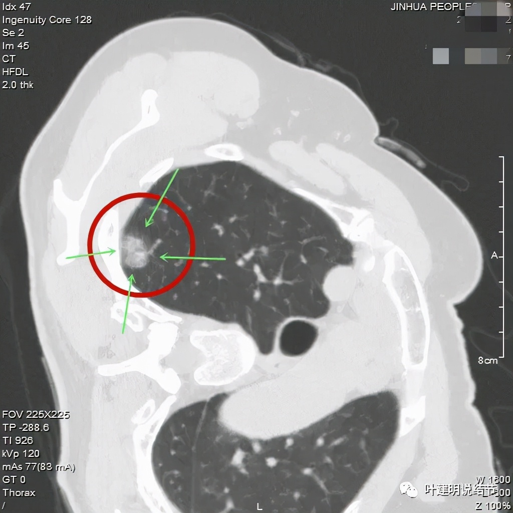 怎样从病理报告看是不是原位癌,原位腺癌切除子宫要开刀吗