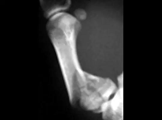 几种严重骨折医学名称,常见的骨折有哪些名称