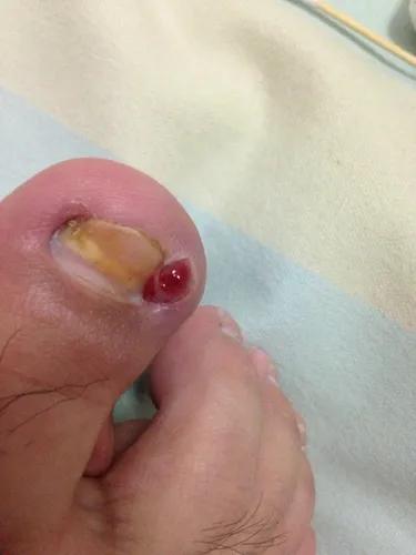 儿童怎么预防甲沟炎,美甲能预防甲沟炎吗