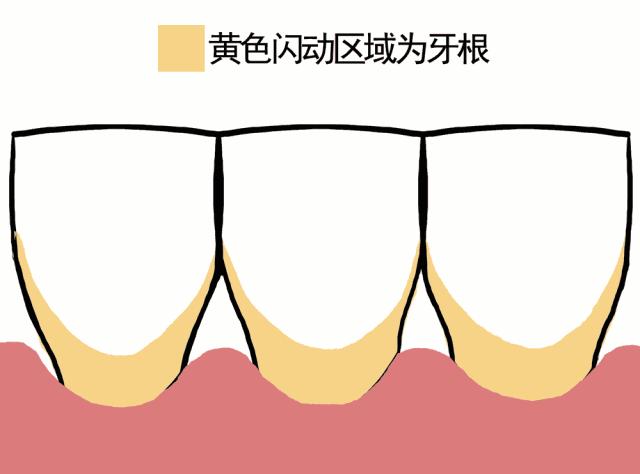 导致牙龈萎缩的4个原因,导致牙龈萎缩的4大原因