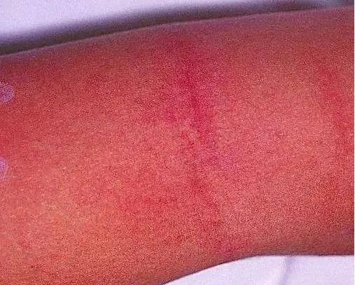 猩红热是皮肤病吗,猩红热样皮炎会传染吗