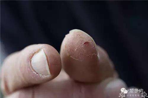 手指每年春天就起泡脱皮怎么治疗,宝宝手指起泡后反复脱皮