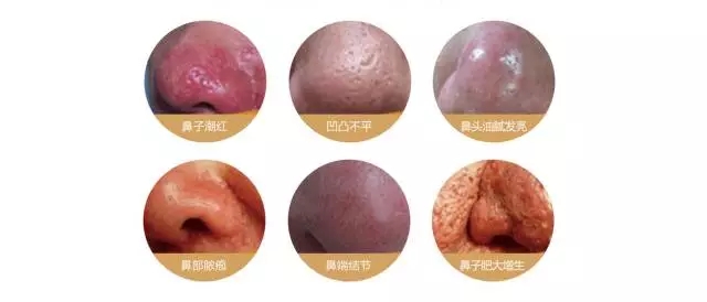 如何应对酒糟鼻,得了酒糟鼻怎么处理好得快