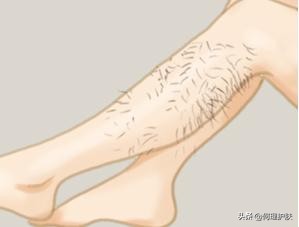 激光脱毛能永久吗脸上,激光脱毛能永久吗知乎