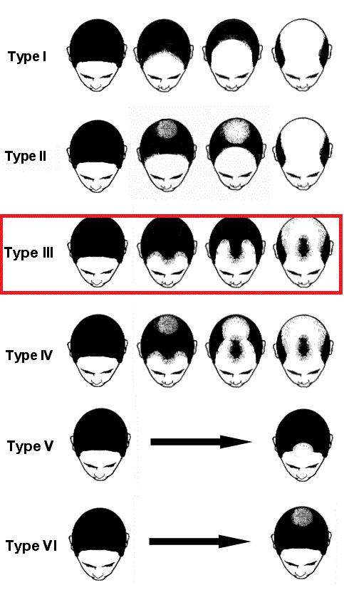 裘德洛的秃头适合什么发型,裘德洛秃顶