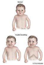 3岁咳嗽到什么程度要送医院,咳嗽去医院也要去发热门诊吗