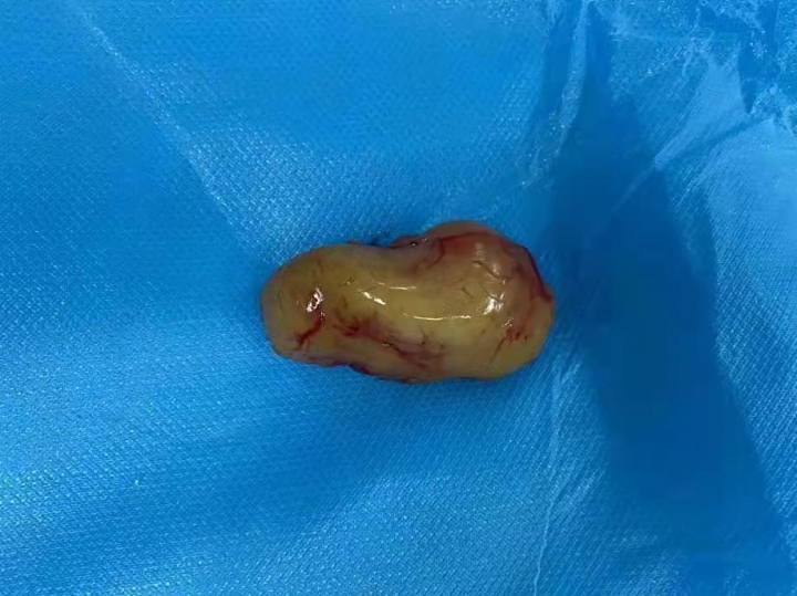 寤跺ぇ闄勫睘鍖婚櫌鑲跨槫,棰岄潰娣遍儴鑲跨槫鎬庝箞娌荤枟