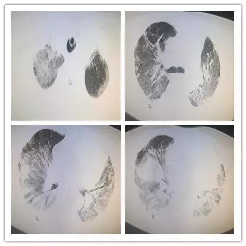 呼吸困难为主要症状的住院大病历,病人出现呼吸困难症状