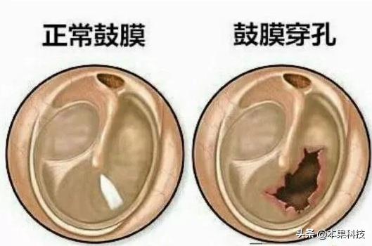 怎么判断耳朵鼓膜是否破了,宝宝掏耳朵把鼓膜掏破了会自愈吗