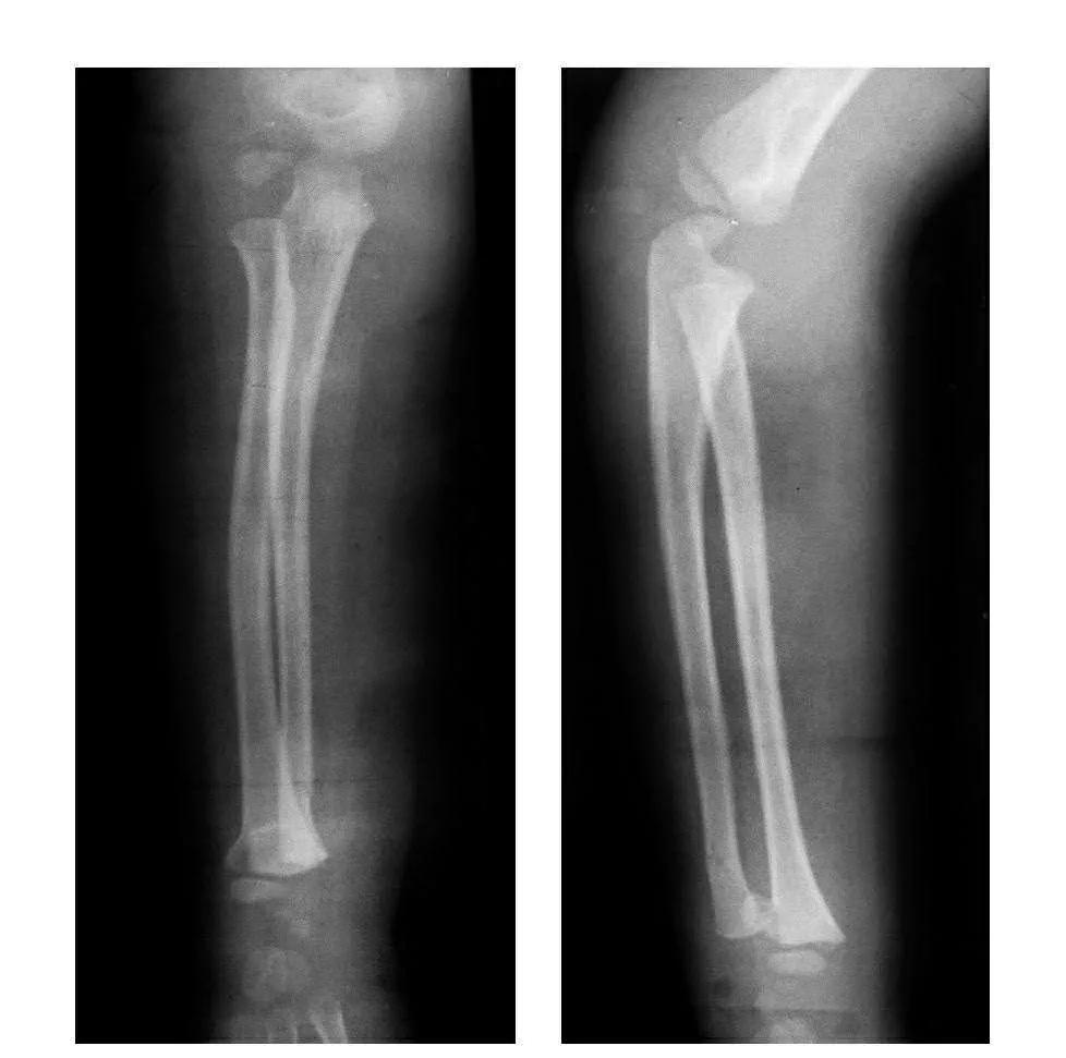 青少年肘部损伤最常见的是,肘部桡神经损伤的临床表现