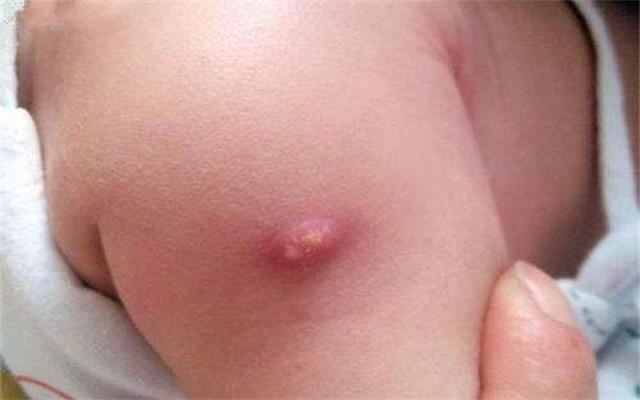 新生儿手臂上有个脓包怎么回事,宝宝出生6天手臂上有脓包