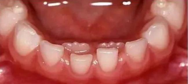 儿童长双排牙怎么让乳牙掉得更快,乳牙没掉新牙成双排牙