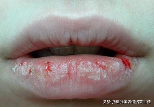 唇色发紫和唇色深,唇色深怎么办四大技巧改善唇色深