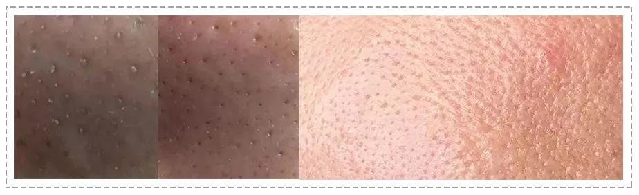 毛孔粗大最好的方法目前最有效的,毛孔粗大怎么缩小自然方法