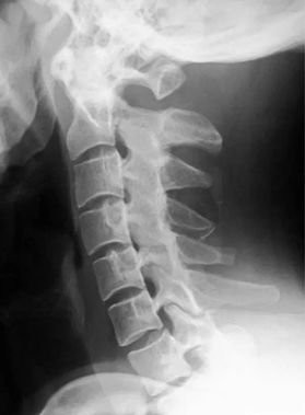 青少年颈椎痛怎么治,青少年父母要注意什么