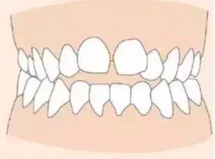 你需要去做个牙齿矫正是什么意思,为什么要做牙齿正畸