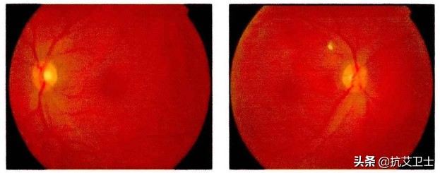 感染HIV后，这里感觉不如从前了