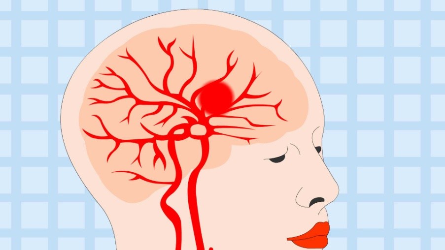 颅内动脉闭塞患者的治疗之路