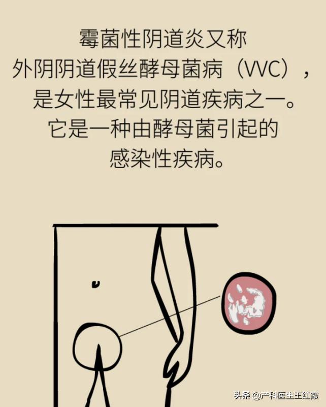 白带增多、脓性灰黄色伴豆渣样、霉菌性阴道炎真的是“发霉”了吗