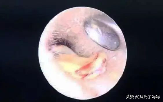 小孩长期不挖耳屎的危害,男童4年没有挖耳屎